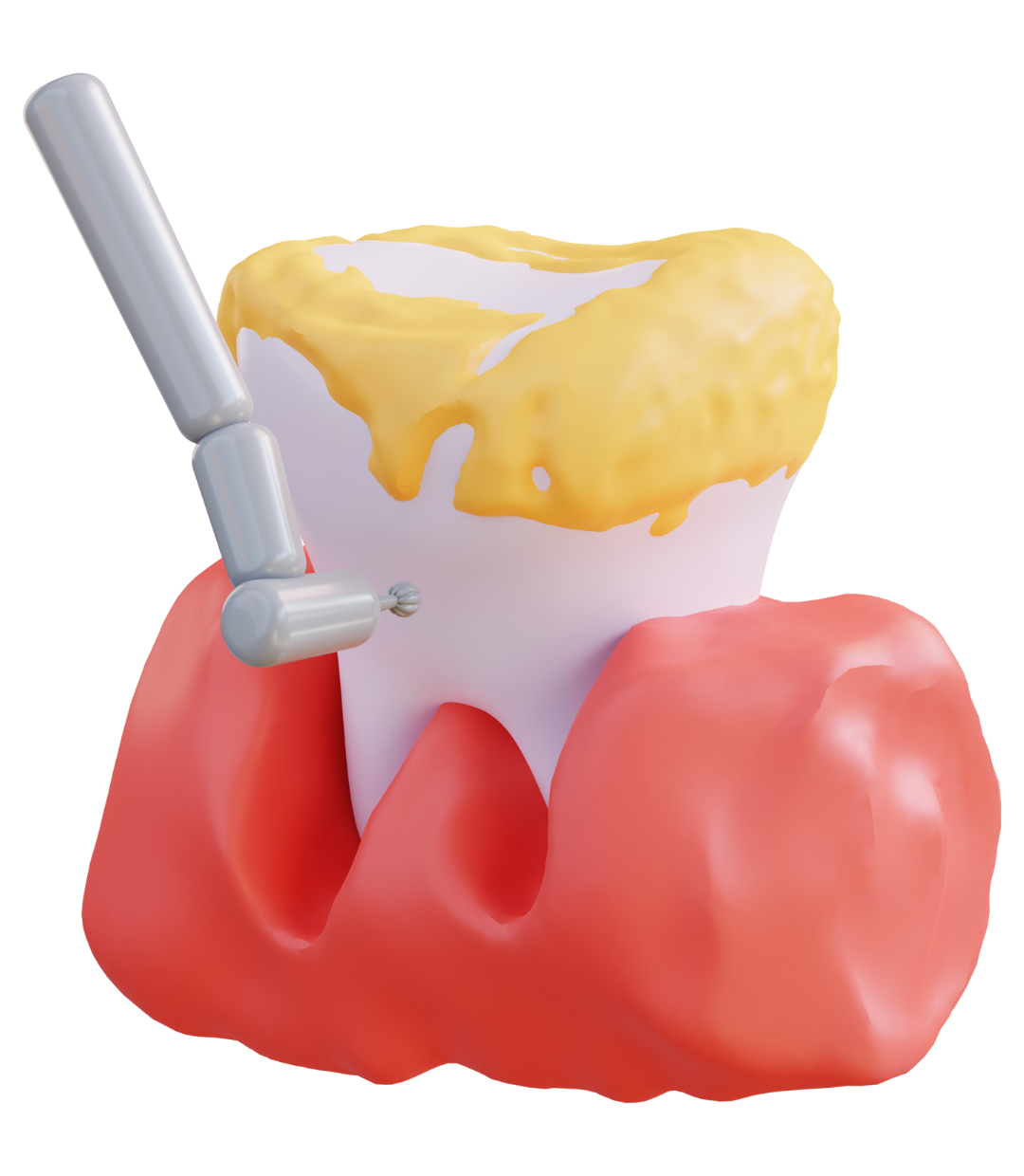 Limpieza Dental